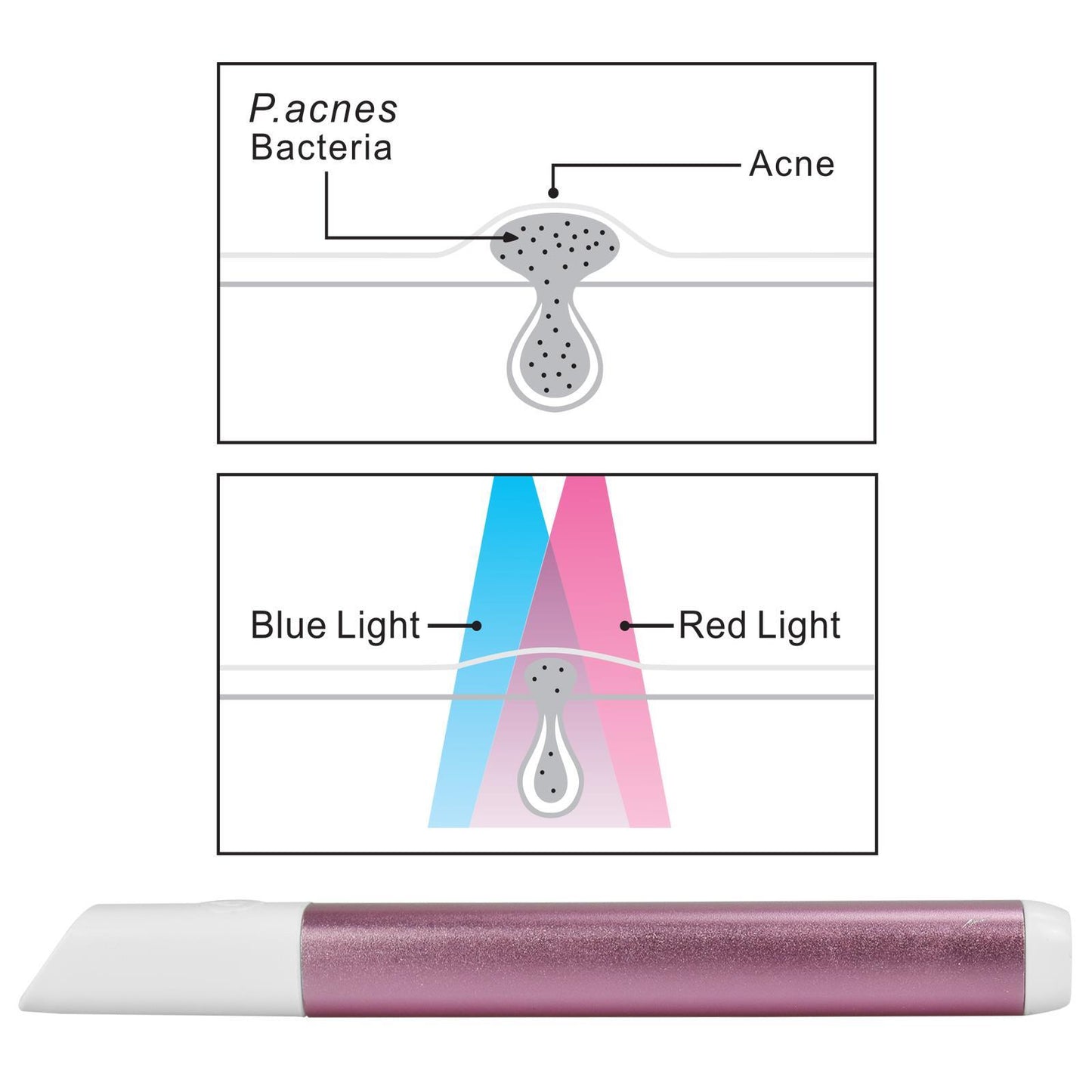 Light Therapy Acne Spot Treatment - Pink AS-61683